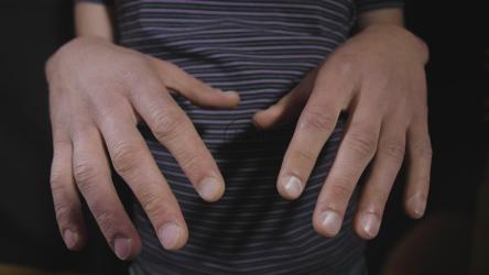 帕金森；s病人[]