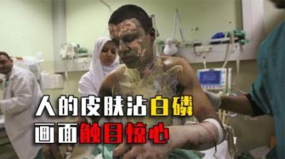 人的皮肤沾到白磷有多可怕？用水都浇不灭！战场上白磷弹更恐怖