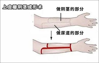 变性冷知识：变性手术真的是切一下就完事儿了吗？