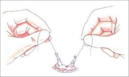 为什么要倡导男人结扎？