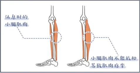 睡觉时伸个懒腰，为啥腿会抽筋？