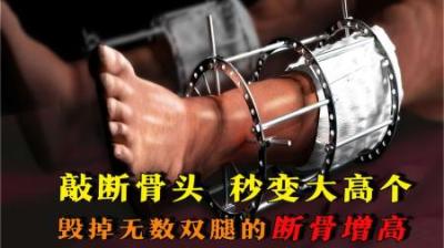 [视]敲断骨头，秒变大高个，断骨增高究竟有多恐怖？