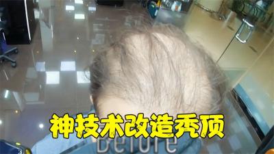 美国理发师的神仙换头术，神技术改造脱发裘千尺，前后判若两人-原创解说文案
