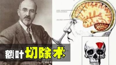 人类历史上最惨痛的一段历史！因为造出“活死人”得了诺贝尔奖？-原创解说文案