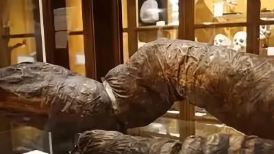 美国男子患先天性巨结肠症，体内取出2.4米大便最终被憋死 .马特博物馆