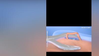 男性绝育手术（输精管结扎）原理、过程及恢复生育能力讲解 .男士如何备孕