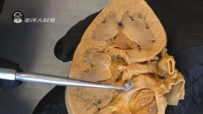 长期吃宵夜饮食不规律，肾脏、胃部等身体器官会有惊人变化 .肾结石