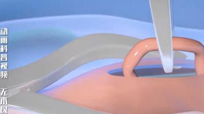 3D动画详解男性绝育手术：输精管结扎与复通过程 .男士如何备孕