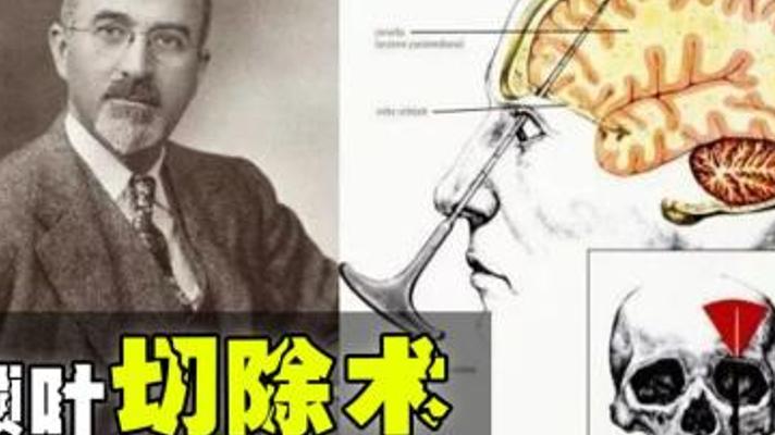 人类医学黑历史：额叶切除术让三十万患者成活死人
