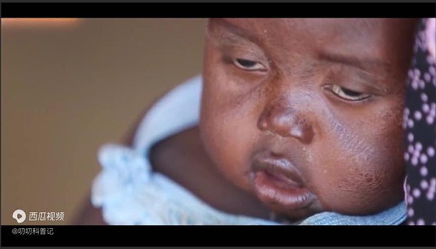 蚊子为何偏爱叮咬你叮咬后并非只起包那么简单